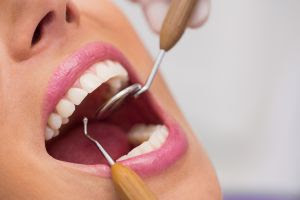 Especialista esclarece principais dúvidas sobre tártaro nos dentes
